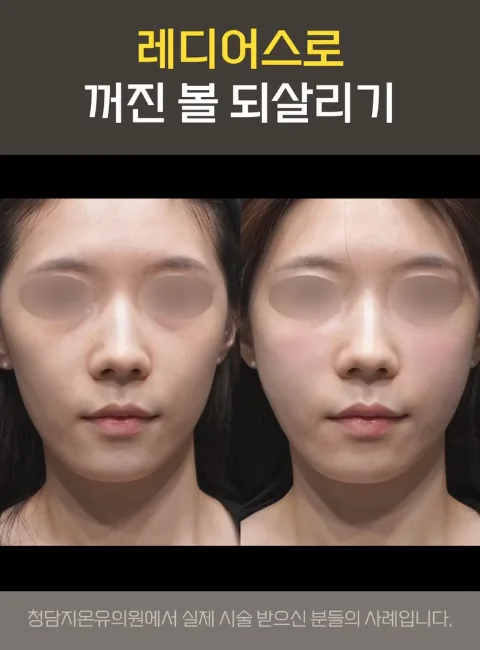 臉頰蘋果肌凹陷