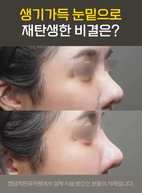 眼下淚溝