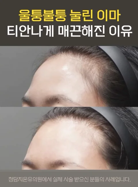 額頭
